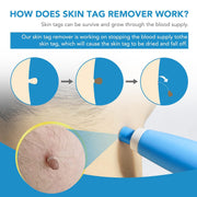 Skin Tag Remover Kit 2 In 1 For Micro To Large (2 Mm - 8 Mm  1 Set) thumbnail 6