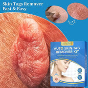 Skin Tag Remover Kit 2 In 1 For Micro To Large (2 Mm - 8 Mm  1 Set) thumbnail 4