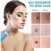 Skin Tag Remover Kit 2 In 1 For Micro To Large (2 Mm - 8 Mm  1 Set) thumbnail 5